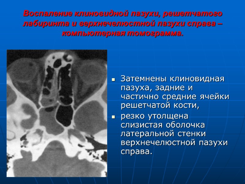 Воспаление клиновидной пазухи, решетчатого лабиринта и верхнечелюстной пазухи справа – компьютерная томограмма.  